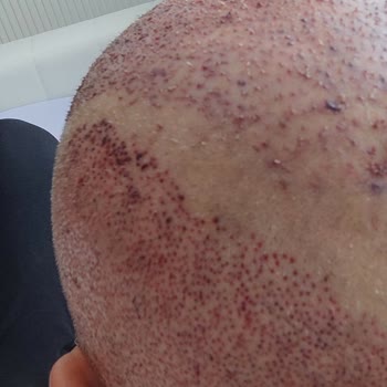 Saç Ekimi Sonuçsuz Kaldı, Merkezden Geri Dönüş Alınamıyor