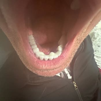 Kıraç Diş Özensiz Diş Tedavisi Sonrası Yaşanan Mağduriyet Ve İade Talebi