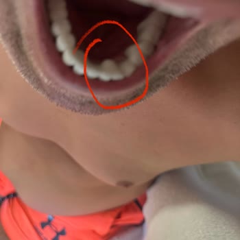 Kıraç Diş Özensiz Diş Tedavisi Sonrası Yaşanan Mağduriyet Ve İade Talebi