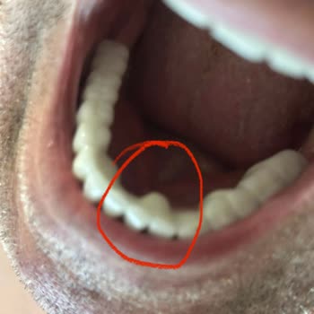 Kıraç Diş Özensiz Diş Tedavisi Sonrası Yaşanan Mağduriyet Ve İade Talebi