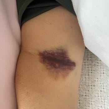 Yoğun Bakımda Yetersiz Bakım Ve Hemşire İhmali Annemin Sağlığını Tehlikeye Attı