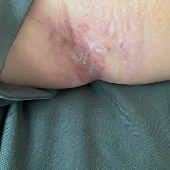 Yoğun Bakımda Yetersiz Bakım Ve Hemşire İhmali Annemin Sağlığını Tehlikeye Attı