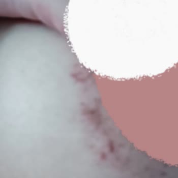 Yanlış Cihazla Yapılan Lazer Sonrası Kalıcı Yanıklar Ve İlgisiz İşletme Mağduriyeti