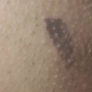 Yanlış Cihazla Yapılan Lazer Sonrası Kalıcı Yanıklar Ve İlgisiz İşletme Mağduriyeti