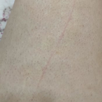 Yanlış Cihazla Yapılan Lazer Sonrası Kalıcı Yanıklar Ve İlgisiz İşletme Mağduriyeti