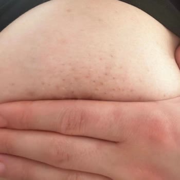 Yanlış Cihazla Yapılan Lazer Sonrası Kalıcı Yanıklar Ve İlgisiz İşletme Mağduriyeti