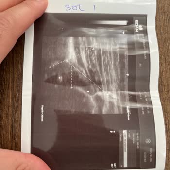 Ankara Bilkent Şehir Hastanesi Yanlış Kalça Ultrasonu Sonucu Gereksiz Tedavi Ve Maddi Mağduriyet