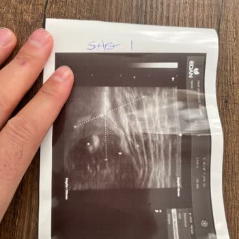 Ankara Bilkent Şehir Hastanesi Yanlış Kalça Ultrasonu Sonucu Gereksiz Tedavi Ve Maddi Mağduriyet