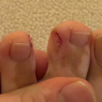 Boynerden Alınan Ayakkabılar Sağlık Sorunu Yaşattı İade Reddedildi