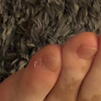 Boynerden Alınan Ayakkabılar Sağlık Sorunu Yaşattı İade Reddedildi