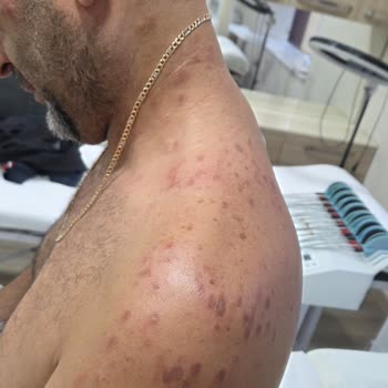 Dr. Med Estetik Ve Güzellik Lazer Epilasyon Sonrası Ciddi Yanıklar
