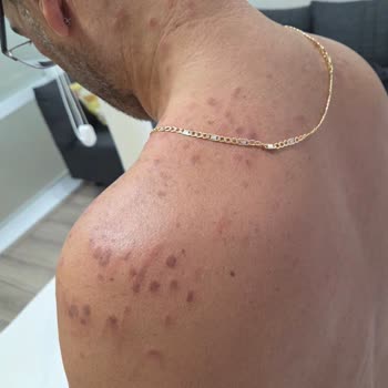 Dr. Med Estetik Ve Güzellik Lazer Epilasyon Sonrası Ciddi Yanıklar