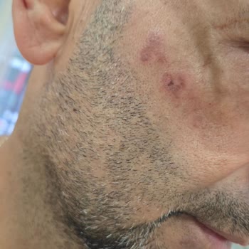 Dr. Med Estetik Ve Güzellik Lazer Epilasyon Sonrası Ciddi Yanıklar