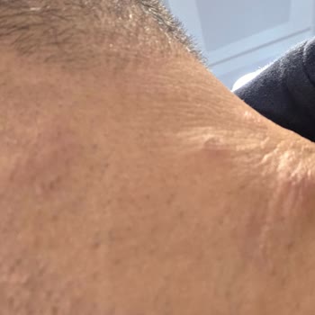 Dr. Med Estetik Ve Güzellik Lazer Epilasyon Sonrası Ciddi Yanıklar