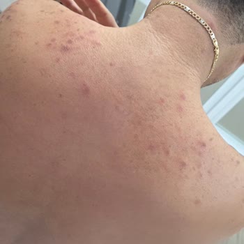 Dr. Med Estetik Ve Güzellik Lazer Epilasyon Sonrası Ciddi Yanıklar