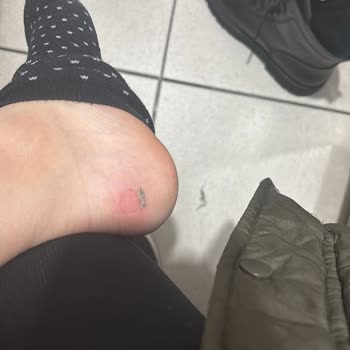 Kısa Süreli Kullanımda Ayağıma Zarar Veren Bot Ve Yetersiz İnceleme Süreci