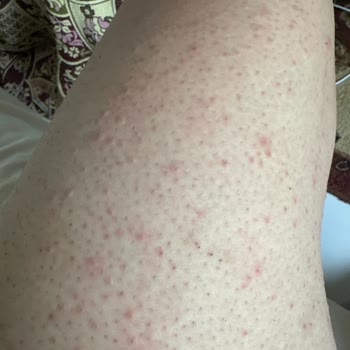 Hassas Ciltlere Uygun Denilen Ürün Ciddi Alerjik Reaksiyona Sebep Oldu