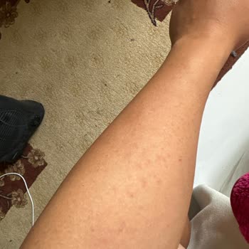 Hassas Ciltlere Uygun Denilen Ürün Ciddi Alerjik Reaksiyona Sebep Oldu