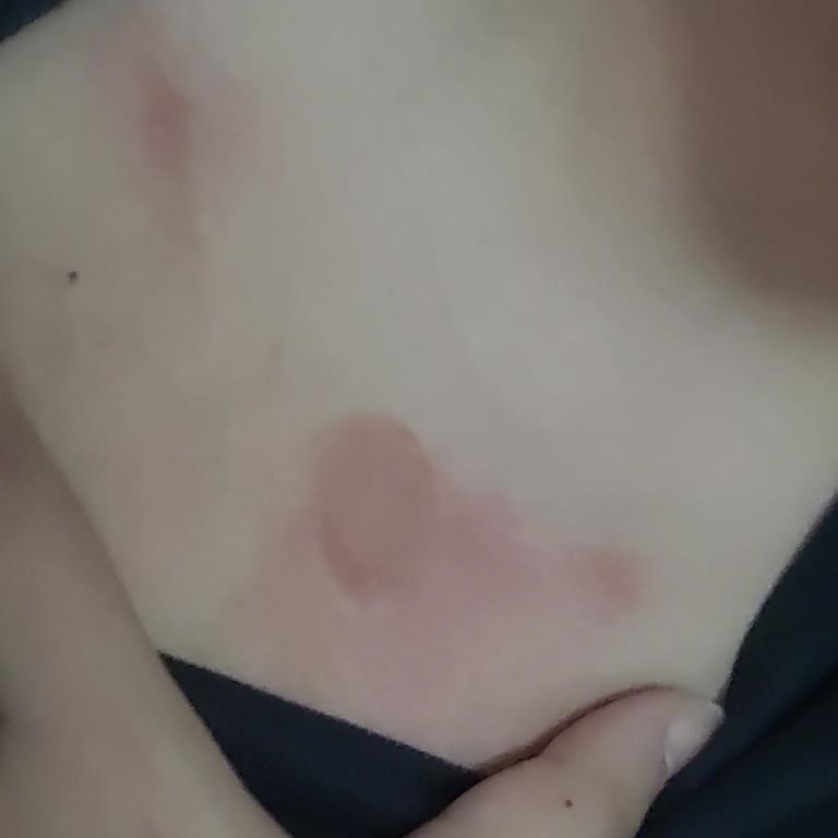 Victoria's Secret Vücut Spreyleri Cildimde Ciddi Alerjik Reaksiyona Yol Açtı