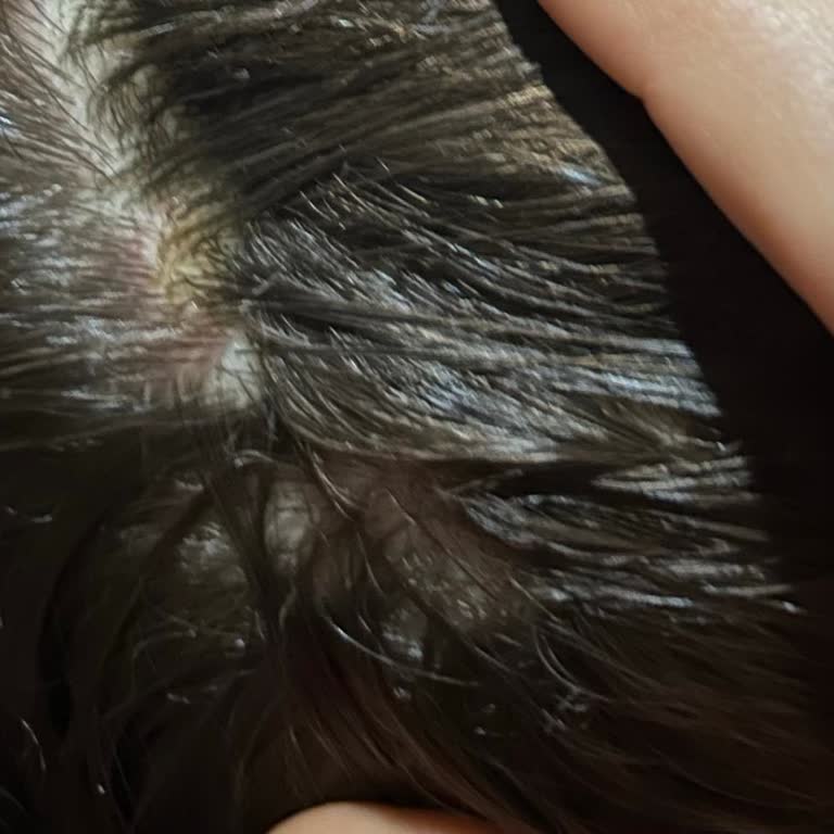 Etkisiz Bit Şampuanı Ve Cilt Tahrişi: Mağduriyetimin Giderilmesini Talep Ediyorum