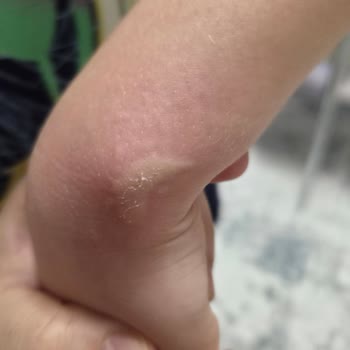 Çocuğumda Ozmo Tükettikten Sonra Tekrarlayan Alerjik Kabarmalar Oluştu