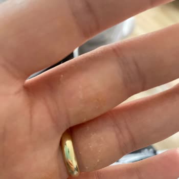 Fairy Bulaşık Deterjanı Ciltte Soyulma Ve Kuruluk Yaptı, Telafi Talep Ediyorum