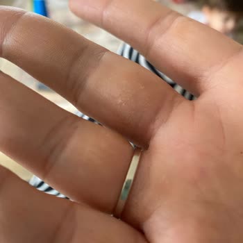 Fairy Bulaşık Deterjanı Ciltte Soyulma Ve Kuruluk Yaptı, Telafi Talep Ediyorum