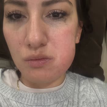 Kanal Tedavisi Sonrası Yüzümde Şişlik Ve Ağrı, Hekim İlgisizliği