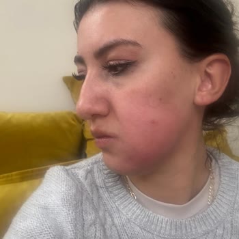 Kanal Tedavisi Sonrası Yüzümde Şişlik Ve Ağrı, Hekim İlgisizliği