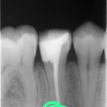 Kanal Tedavisi Sonrası Yüzümde Şişlik Ve Ağrı, Hekim İlgisizliği