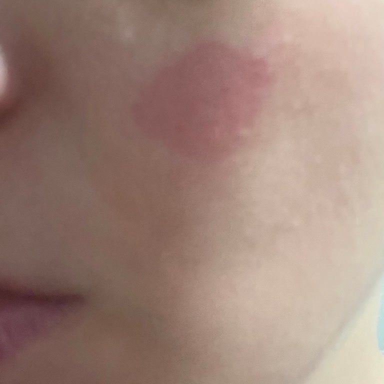 Bebek Kremi Ciltte Alerji Ve Yanma Yaptı, Güvenimiz Sarsıldı