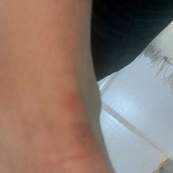 Lumberjack Ayağımı Yaralayan Ayakkabının İadesi Reddedildi, Mağduriyetim Giderilmiyor