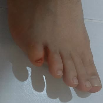 Lumberjack Ayağımı Yaralayan Ayakkabının İadesi Reddedildi, Mağduriyetim Giderilmiyor