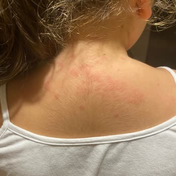 OMO Unilever Çok Ciddi Alerjik Döküntüler Yaşamaya Başladı