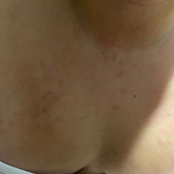 OMO Unilever Çok Ciddi Alerjik Döküntüler Yaşamaya Başladı