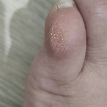 Sol Ayakkabıda Kalıp Hatası Ve Sürekli Rahatsızlık