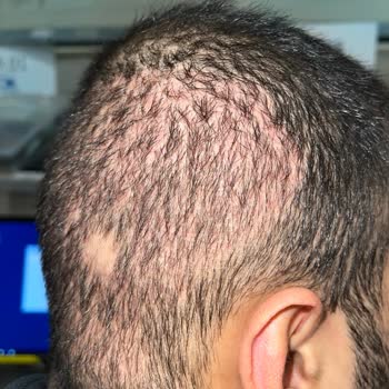 Doktor Yerine Asistanlar Saç Ekimi Yaptı, Sonuç Hayal Kırıklığı Ve Mağduriyet