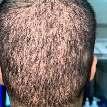 Doktor Yerine Asistanlar Saç Ekimi Yaptı, Sonuç Hayal Kırıklığı Ve Mağduriyet