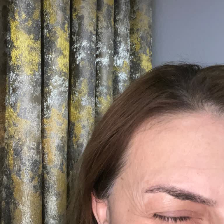 Ozan Balık Estetik Yüz Germe Sonrası Geçmeyen Morluklar Ve Kalıcı Zarar