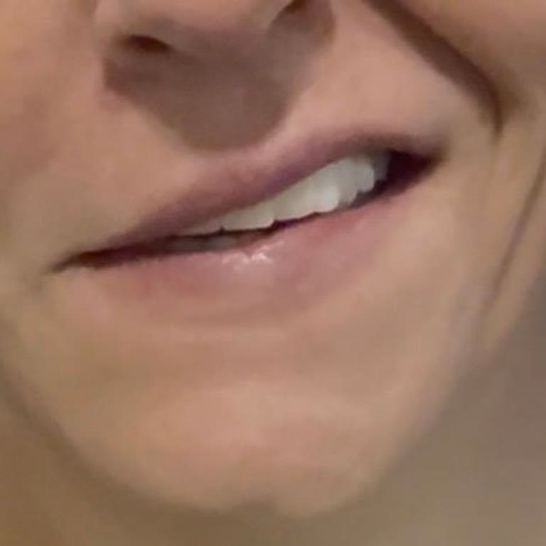 London Dr. Clinics İşlem Sonrası Yaşanan Sorun!