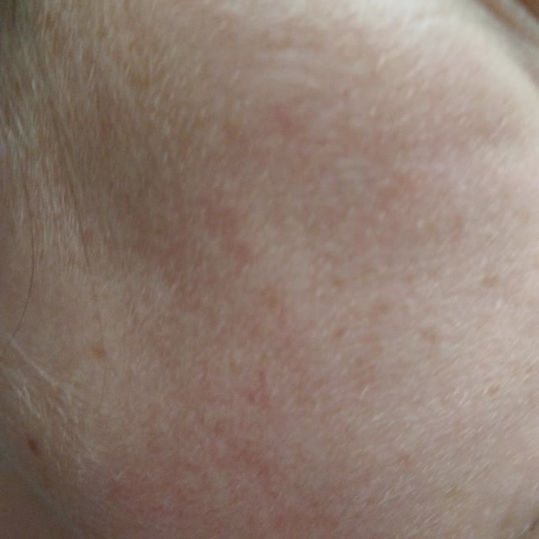 Yanlış Ürün Tavsiyesi Sonucu Ciltte Leke Ve İade Sorunu