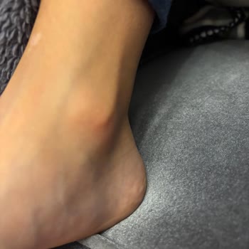 Skechers Kids Ayakkabı Çocuğumda Şiddetli Ayak Şişmesi Ve Kaşıntıya Sebep Oldu