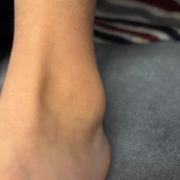 Skechers Kids Ayakkabı Çocuğumda Şiddetli Ayak Şişmesi Ve Kaşıntıya Sebep Oldu