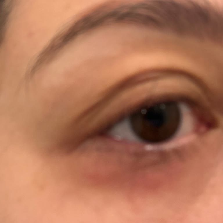 Göz Altı Kremi Cildimde Kaşıntı Ve Kızarıklık Yaptı