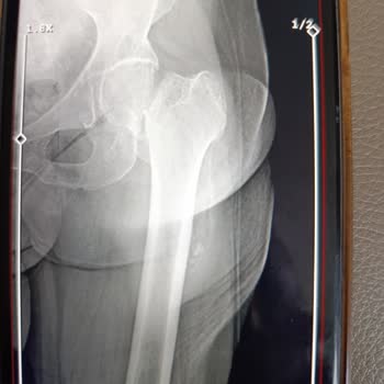 Medicana Sağlık Grubu Acil Serviste Bariz Kalça Kırığı Gözden Kaçtı Annem 15 Gün Acı Çekti