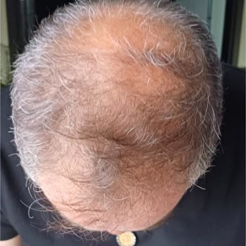 Saç Ekimi Sonrası Hayal Kırıklığı Ve Hastanenin Sorumluluk Almaması