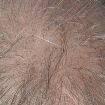 Saç Ekimi Sonrası Hayal Kırıklığı Ve Hastanenin Sorumluluk Almaması