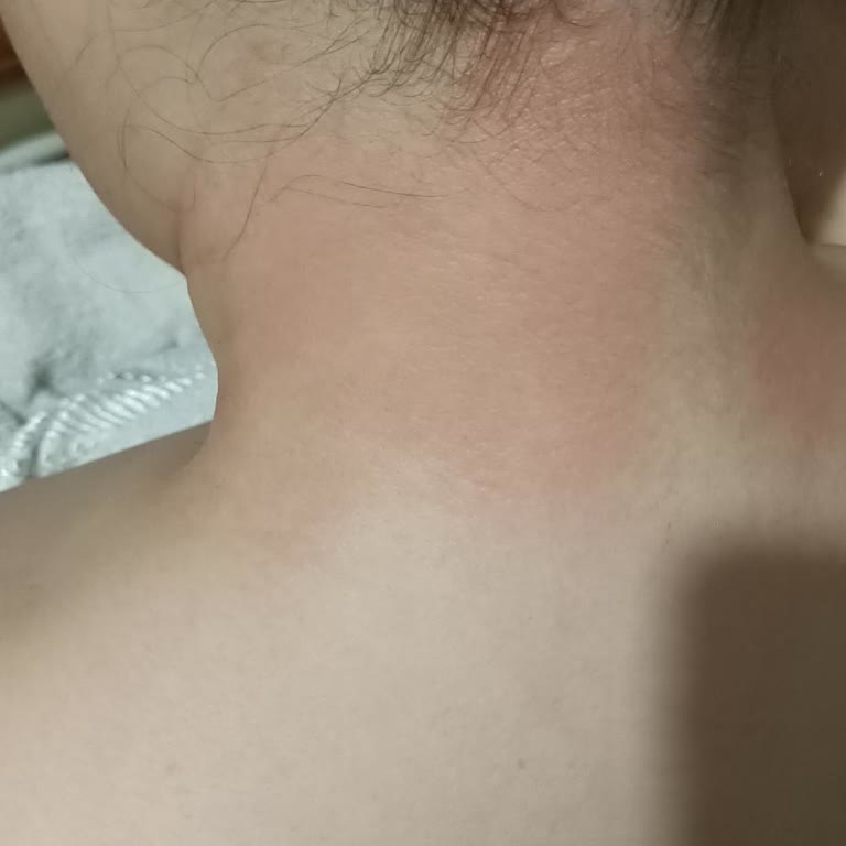 Palmolive Shower Gel Caused Severe Redness, Itching, and Burning on My Neck