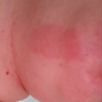 Palmolive Shower Milk Caused Severe Itching and Redness