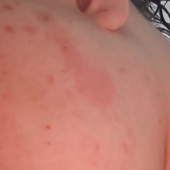 Palmolive Shower Milk Caused Severe Itching and Redness